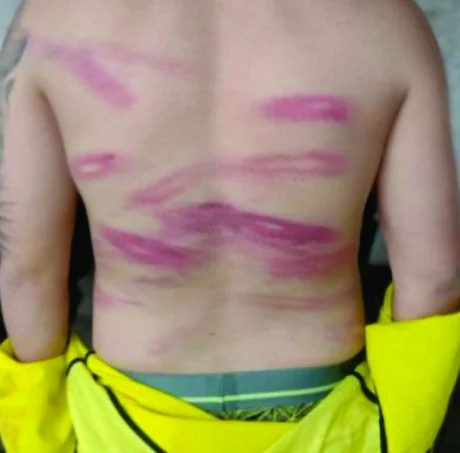 Uno de los detenidos muestra hematomas a raíz de los golpes con cachiporra y palos, además de latigazos.